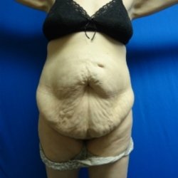 Manhattan abdominoplasty before 11